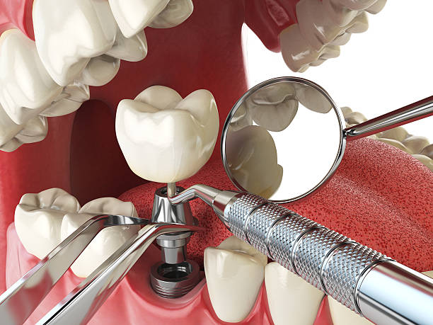 Best Emergency Dentist for Lost Fillings or Crowns in Ahuimanu, HI